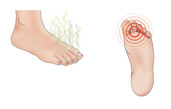 Athlete's Foot Fungus Treatment, Symptoms, Prevention and Causes