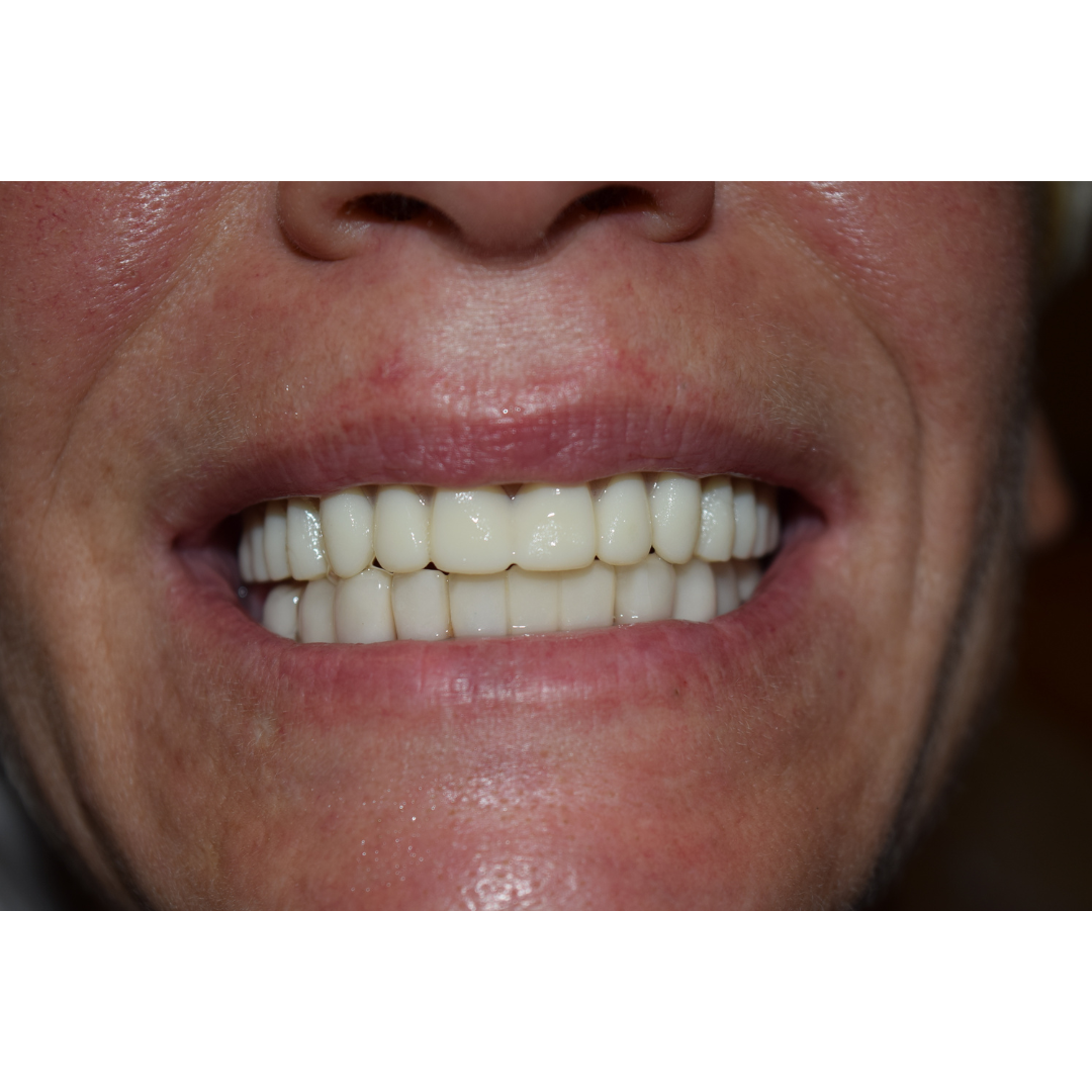 Easy Denture™ - Patient Self Fitting - Less Than 5 Minutes - Upper & Lower Dentures - Senior.com Dentures
